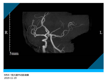 MRA一侧大脑中动脉堵塞 (2).jpg