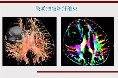 神经纤维束追踪（DTI）.jpg