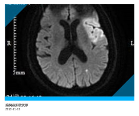 脑梗塞弥散受限.jpg